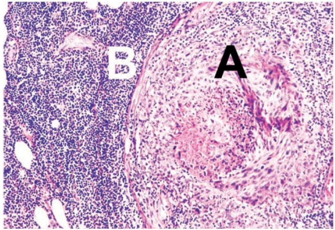 Histologické vyšetření metastázy s masivním lymfocytárním
infiltrátem (a – kožní metastáza, B – lymfocytární infiltrát)