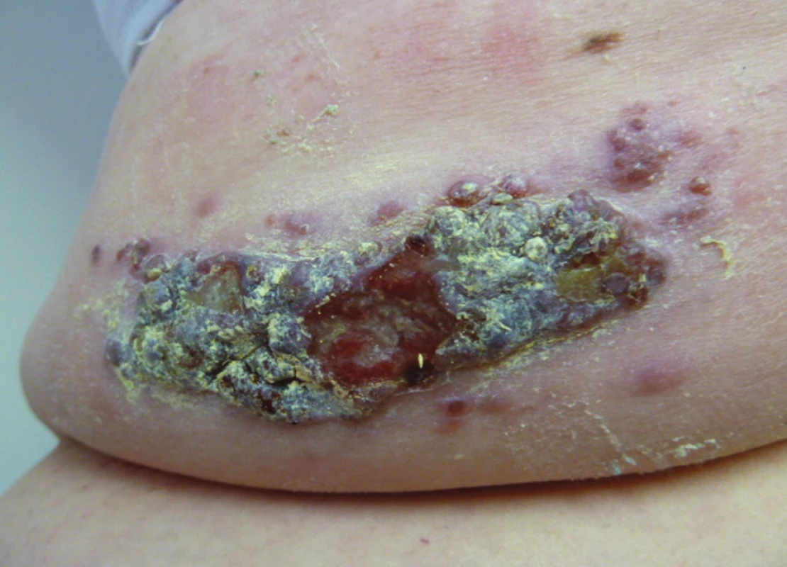 Maligní melanom zad
Fig. 4: Malignant melanoma of the back