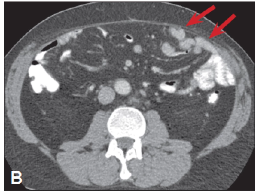 <i>CT břicha – mnohočetná ložiska v levém mezogastriu ventrálně</i>