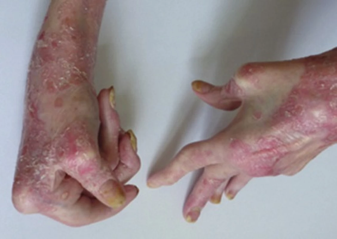 Obraz rozvinuté psoriázy a psoriatické artritidy s četnými deformitami
(fotoarchiv primáře Gkalpakiotise, Dermatovenerologická klinika FNKV)