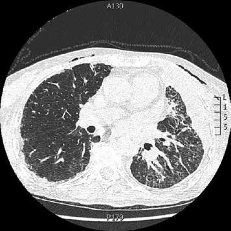 CT hrudníku: kryptogenní organizující se pneumonie