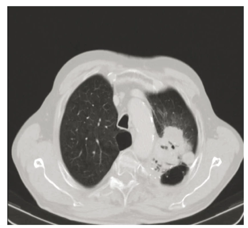 CT hrudníku z 14. 3. 2019 – nádorové ložisko
v levém horním laloku