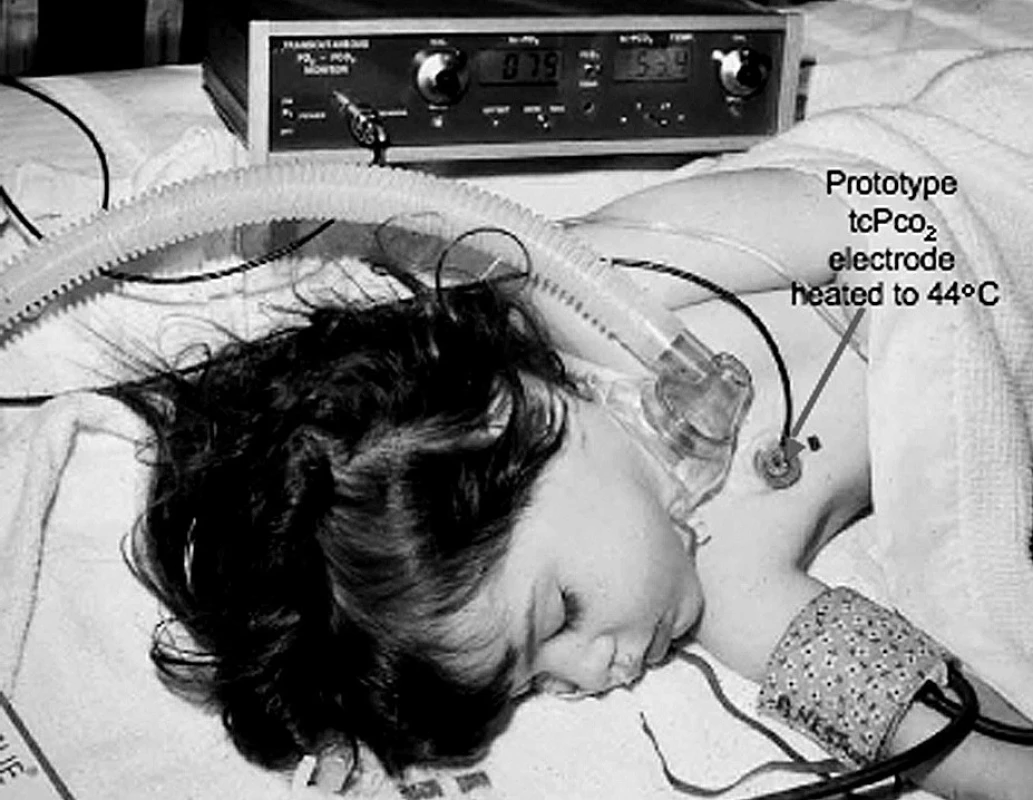 The combined transcutaneous PO2-PCO2 electrode monitoring a child postoperatively