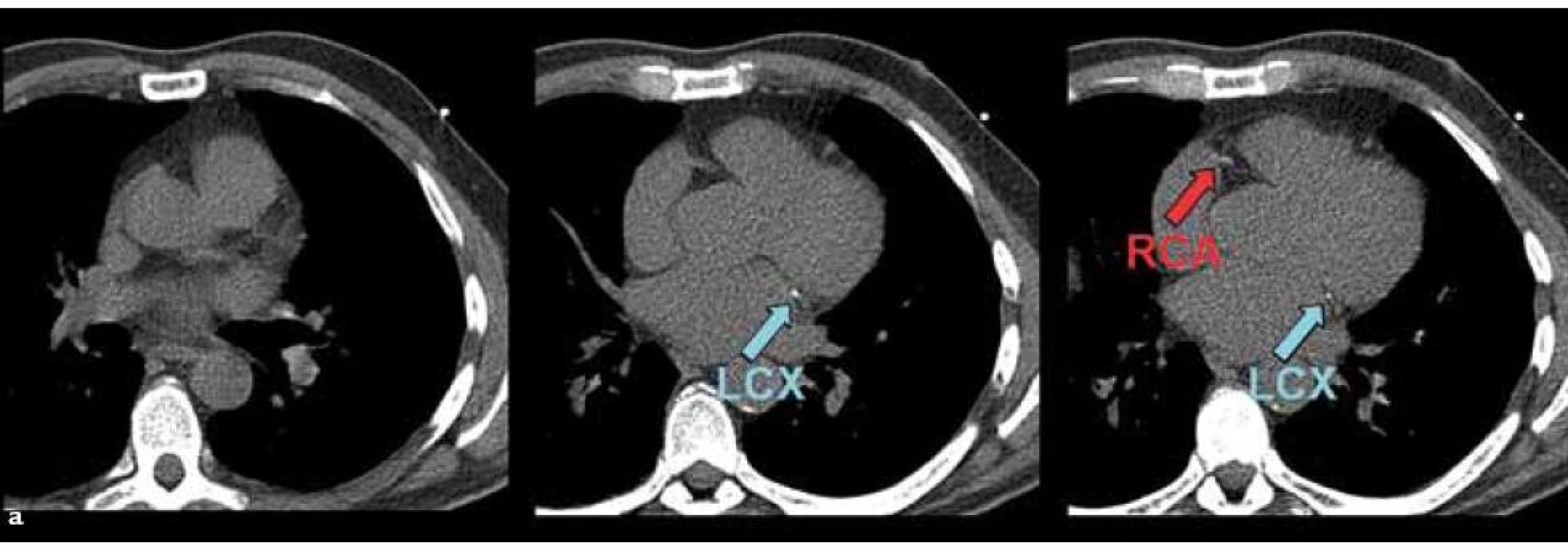 59letý diabetický pacient měl na CT (a) zobrazeny pouze drobné kalcifikace v povodí ramus circumflexus (left circumflex artery – LCX) a pravé koronární tepny (right coronary artery – RCA). Celkové kalciové skóre bylo jen mírně zvýšené na 56.