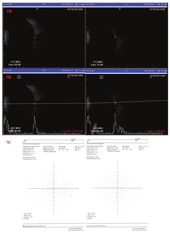 Sonografie a perimetr OPL
7A – B scan, 7B – A i B scan – Oboustranně patrné obrovské drúzy papily ZN. 7C - perimetrické vyšetření – OP fyziologický nález, OL – ojediněle relativní skotomy, jinak fyziologický nález