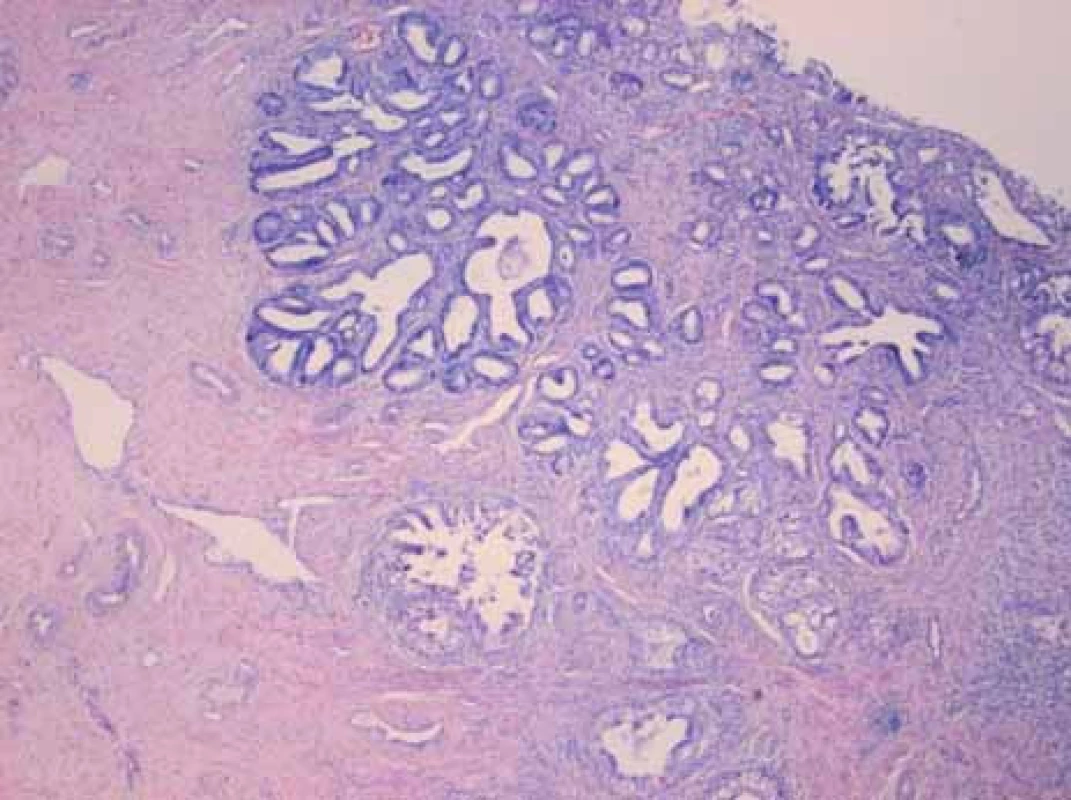Cervikální typ invazivního mucinózního karcinomu cervixu. HE, 4×.