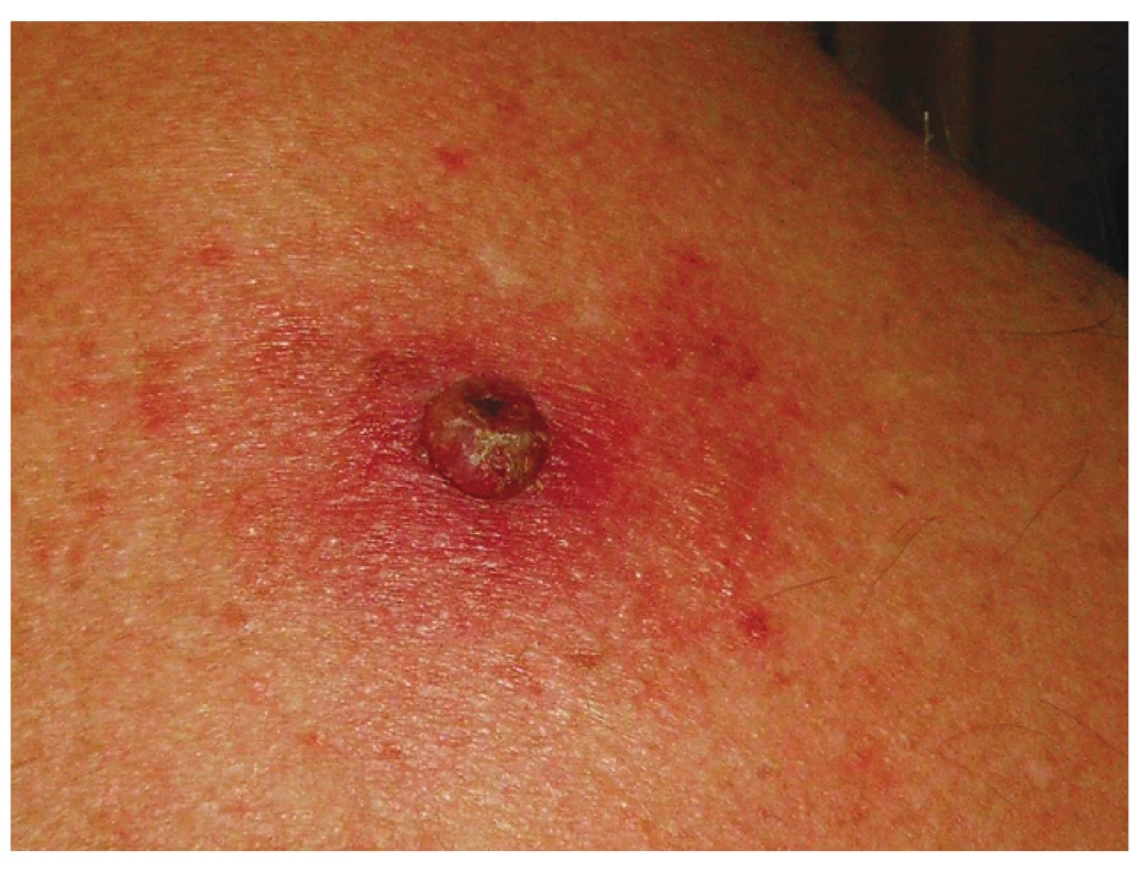 Primární melanom
(zdroj: Dermatovenerologická klinika VFN)