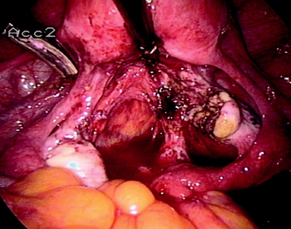 Stav po resekci endometriomu ovaria vpravo