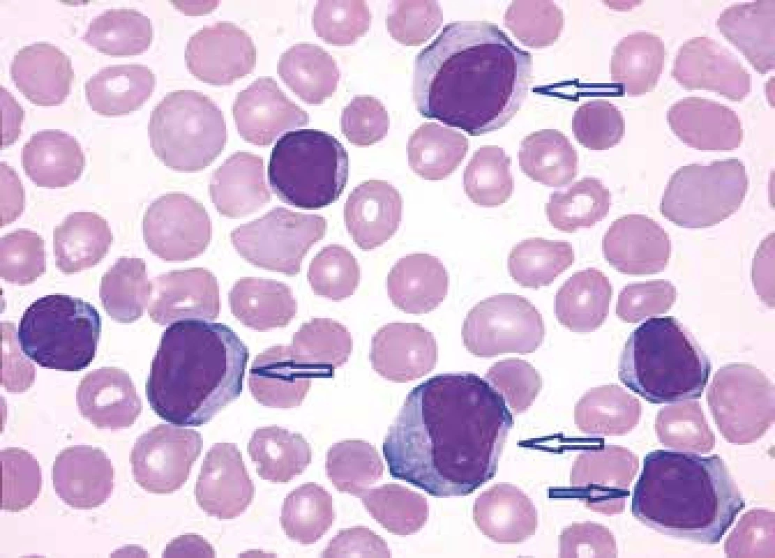 Atypická CLL – varianta CLL/PL (šipkami jsou označeny prolymfocyty – středně velké lymfocyty s bohatou bazofilní cytoplazmou, méně kondenzovaným jaderným chromatinem a výraznými nukleoly), periferní krev, barvení Maye-Grünwalda, Giemsy-Romanowského