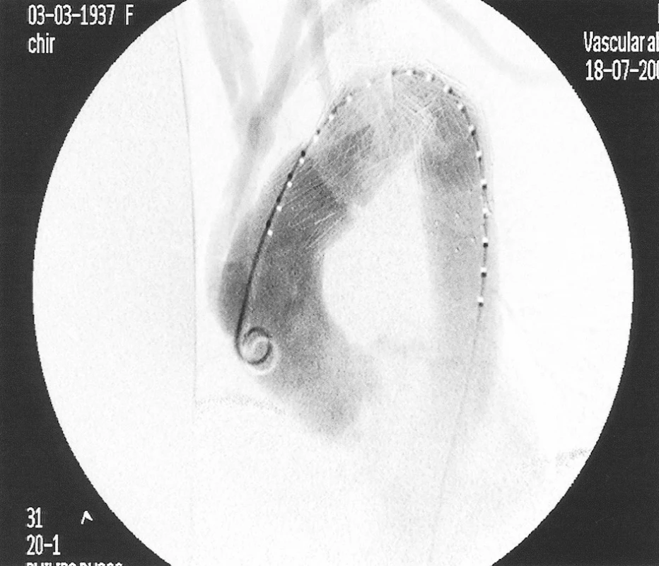 Peroperation angiography after introduction of stent-grafts
Obr. 4. Peroperační angiografie po zavedení stentů