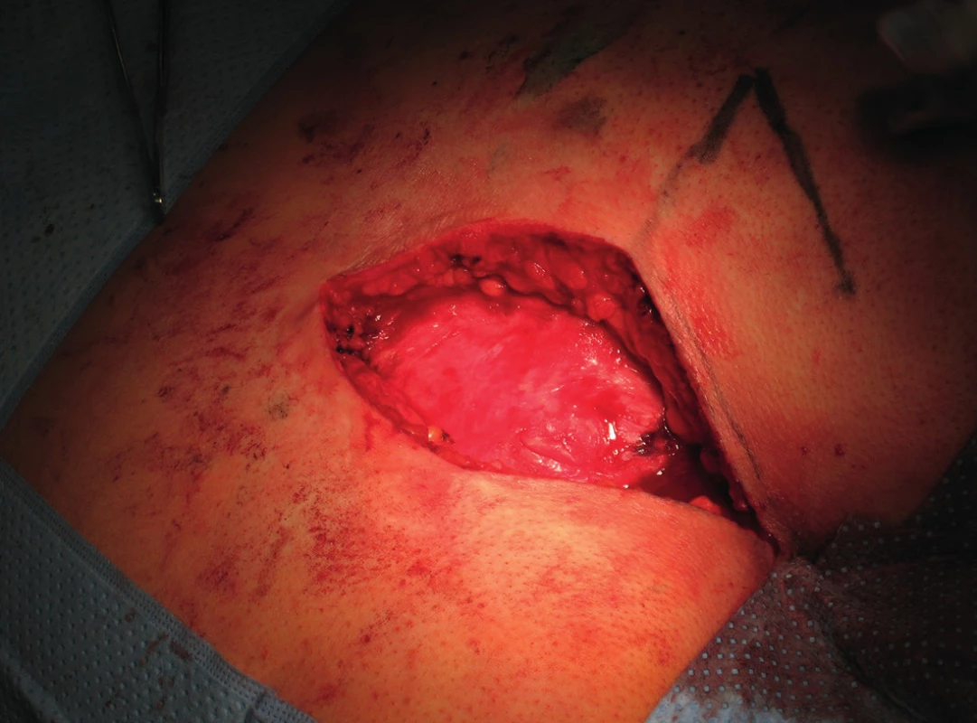 Radikální excize měkkých tkání s píštělí
Fig. 2: Radical excision of soft tissues with fistula