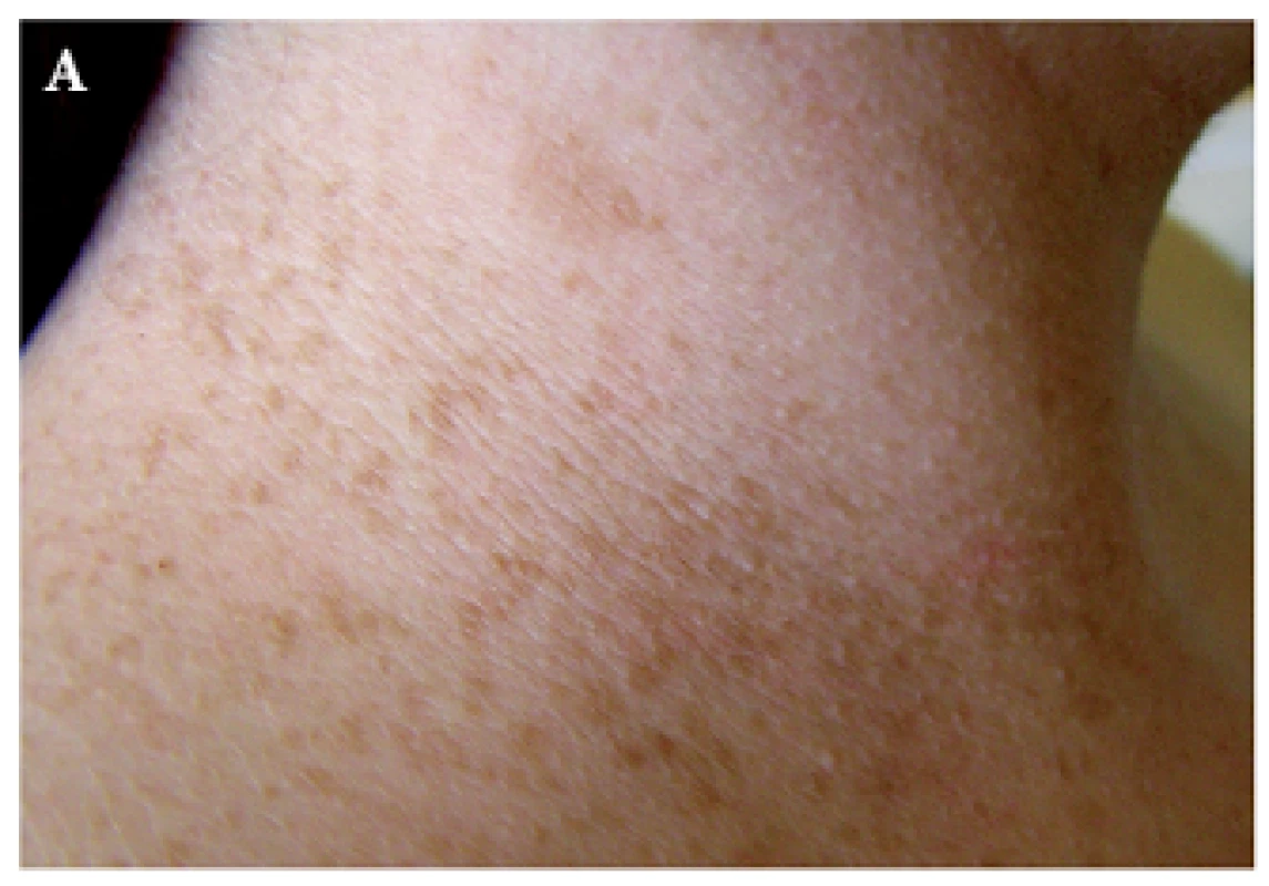 Hyperpigmentace na krku (A) a v axille (B) Dříve označovaná jako Croweho znamení, nyní jako freckling.