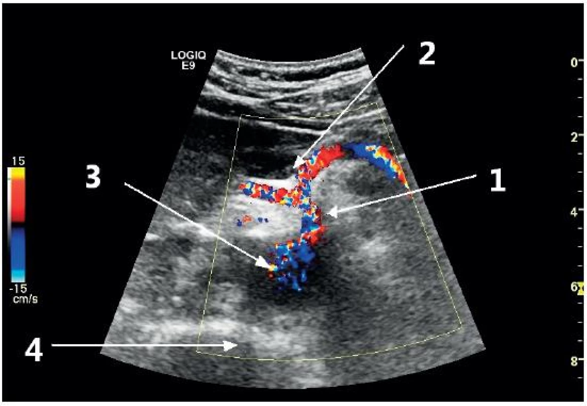 Příčné zobrazení proximální břišní aorty v úrovni odstupu truncus coeliacus (barevný Doppler)