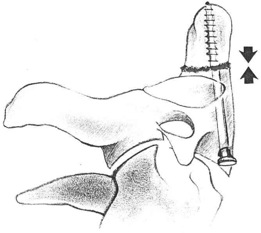 Kompresní osteosyntéza šroubem
Fig. 2. Comression osteosynthesis with a screw