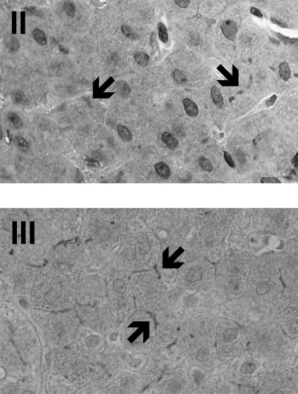 ImunohistologieMDR3 v jaterní tkáni probandek II a III. Šipkami je označeno pozitivní imunobarvení proteinu MDR3, který je přítomen v kanalikulární membráně hepatocytů. Původní zvětšení 400x.
Fig. 1. Immunohistology of MDR3 in liver tissue of the female probands II and III. The arrows indicate positive immunostaining of MDR3 protein which is present in the hepatocyte canalicular membrane. Original magnification 400-fold.