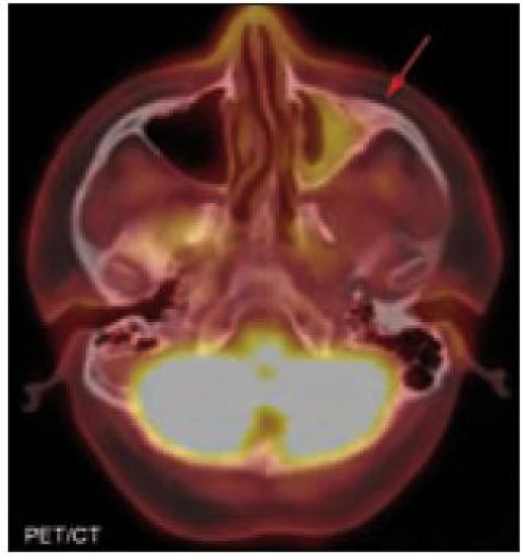 PET/CT hlavy. Sklerotizace mediální části levé jařmové kosti. PET komponenta zachycuje difuzně zvýšenou aktivitu radiofarmaka 2-[&lt;sup&gt;18&lt;/sup&gt;F]-fluoro-2-deoxy-D-glukózy (&lt;sup&gt;18&lt;/sup&gt;F-FDG) v místech strukturálních změn popisovaných na CT.