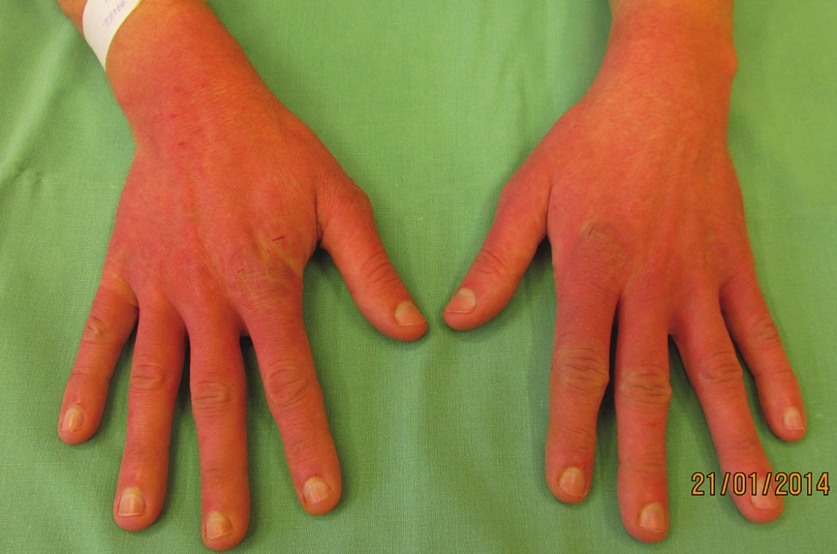 Rukavicové postižení rukou, erytém až purpurový nádech kůže