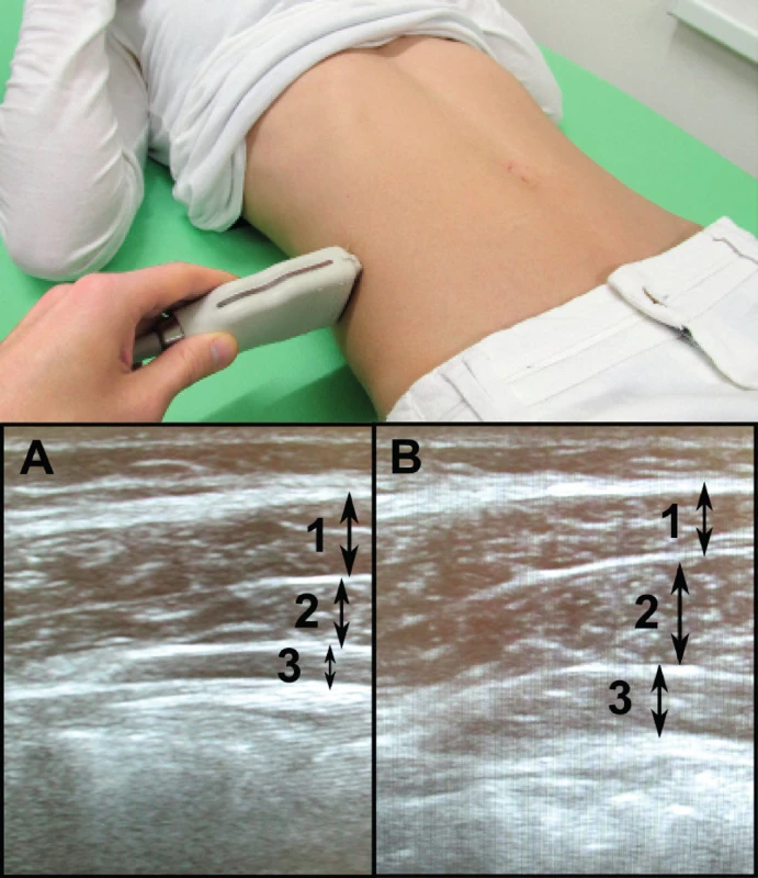 Nahoře poloha sondy při měření tloušťky břišních stabilizačních svalů, dole sonografický obraz musculus obliquus abdominis externus (1), obliquus abdominis internus (2) a transversus abdominis (3) v klidu (A) a při zátěži (B).