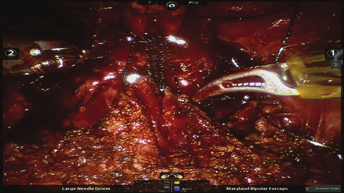 Nasazení prvních stehů při šití veziko-uretrální anastomózy
Fig. 7: Placing the first sutures on the vesicourethral anastomosis