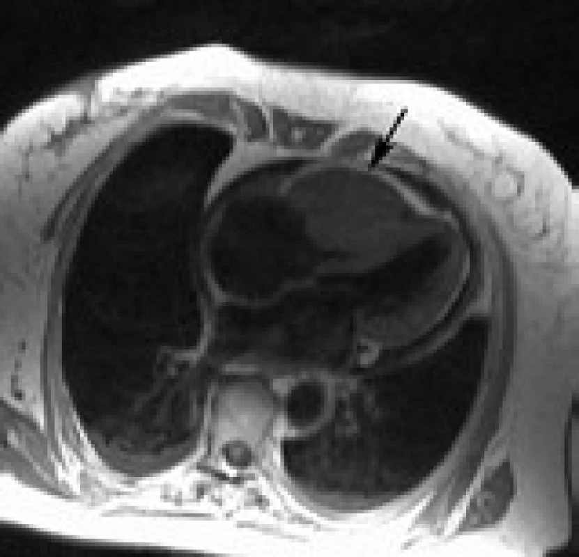 MR zobrazení srdce v horizontální dlouhé ose, v pravé srdeční komoře rozsáhlá tumorózní expanze vyplňující většinu dutiny (hrot šipky), T1 vážený obraz turbospinální echo.