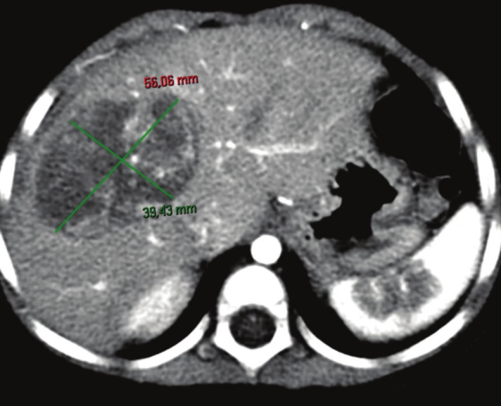 Zmenšenie nádoru po neoadjuvantnej liečbe, pacient č. 2
Fig. 4: Tumor shrinking after neoadjuvant therapy, patient No. 2