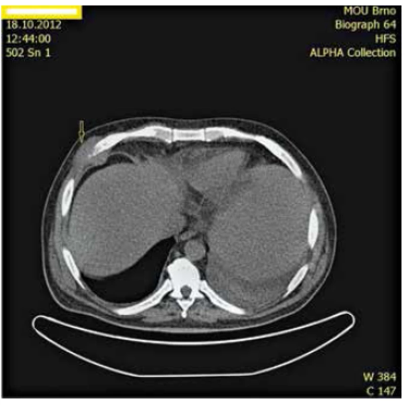 CT snímek nádorového ložiska v hrudní stěně.