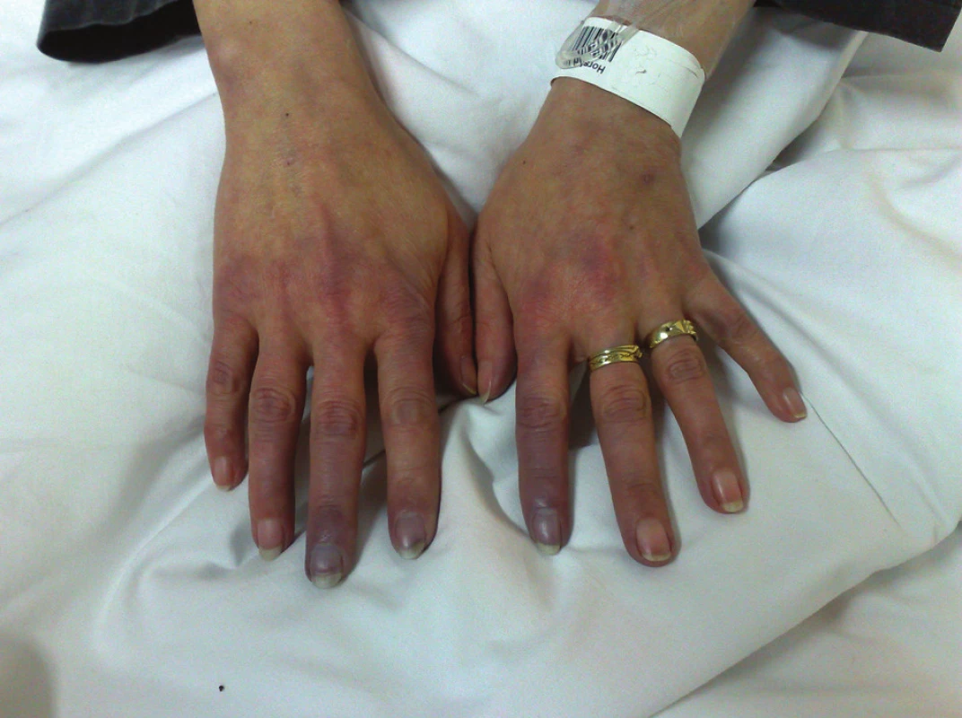 Pacientka se systémovou sklerodermií léčená prostanoidy za hospitalizace pro těžké ataky RF a počínající ulcerace (stav po záchvatu RF s trvající cyanózou zejména 2. prstu levé a 2. a 3. prstu pravé ruky).