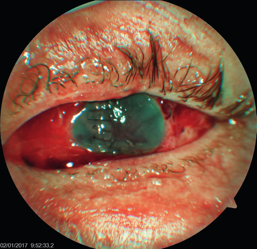 Fotografie předního segmentu levého oka druhý den po úrazu (popálení řas, subkonjunktivální sufuze a zašedlá rohovka se suturou od čísla 11 k číslu 4)