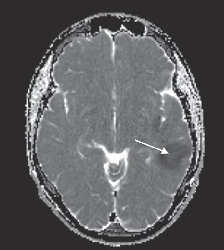 Magnetická rezonance mozku u 17letého chlapce s infekční endokarditidou na bikuspidální aortální chlopni a septickou embolizací v temporo-insulární oblasti vlevo (šipka) – asignální oblast v ADC (apparent diffusion coefficient) mapě odpovídá akutní ischemii.