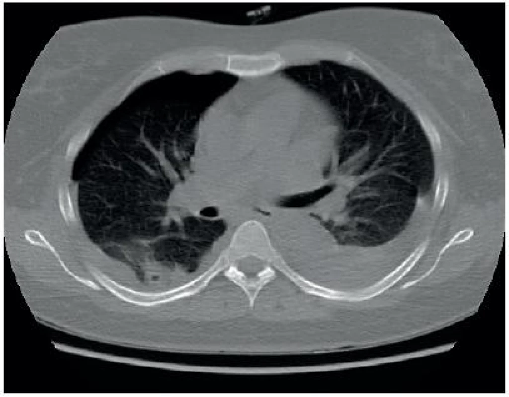 CT angio s nálezem pneumotoraxu vpravo