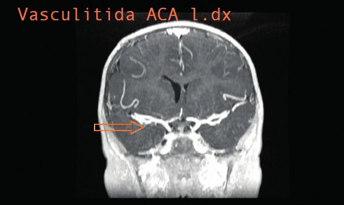 Vaskulitida ACA l. dx.
Fig. 7. Vasculitis of ACA l. dx.