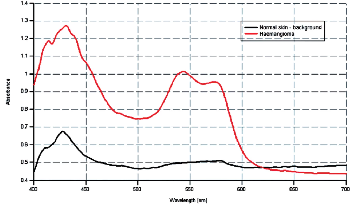 Spektrálne krivky u pacienta s hemangiómom.