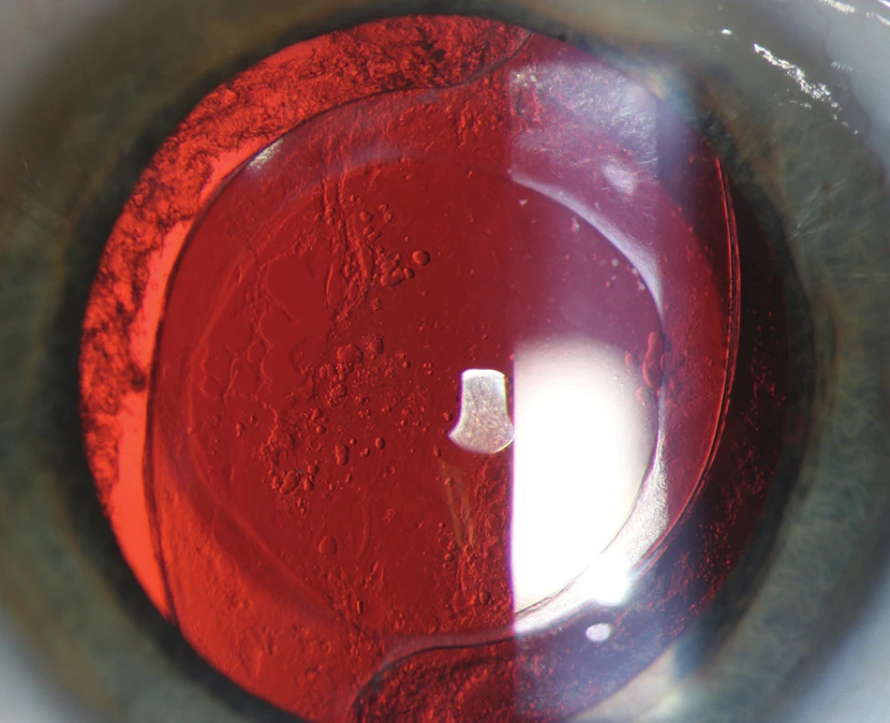 Hanita B lens hydrofilní akrylát – nečištěné pouzdro (33 měsíců od operace) – přítomné ACO+PCO.