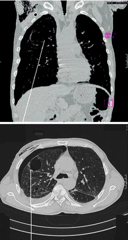 CT izolované plicní buly a parciální PNO
Fig. 1. A CT scan of an isolated pulmonary bule and partial pneumothorax