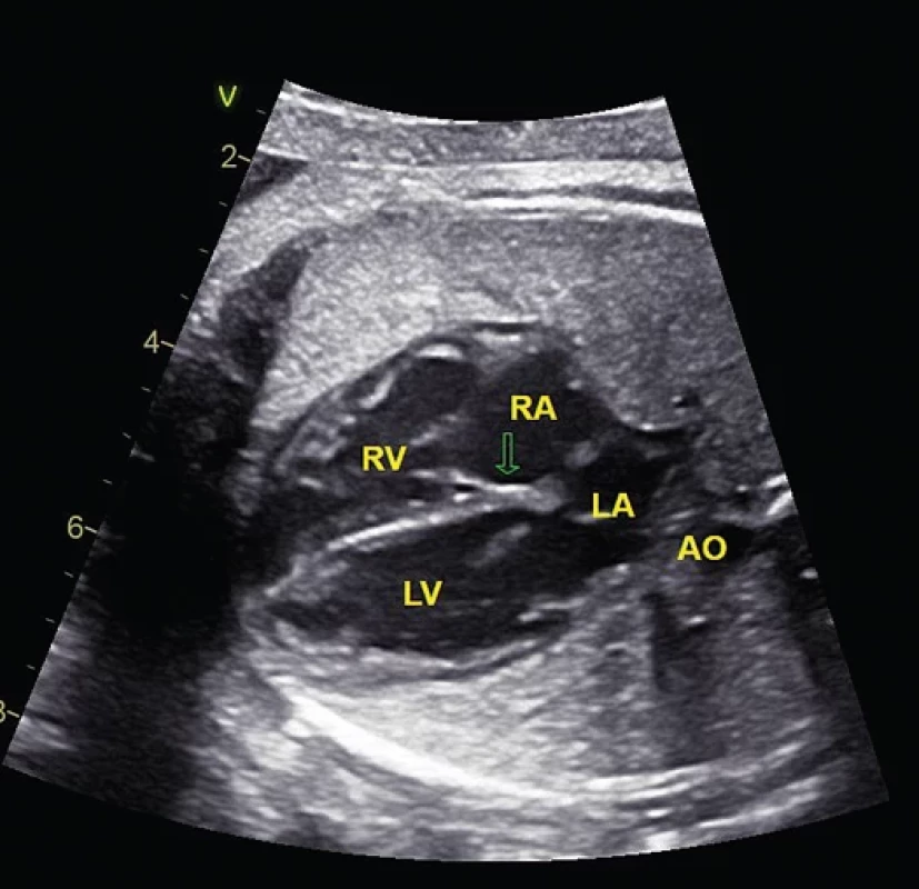 Ultrazvukové vyšetření srdce v transverzální čtyřdutinové projekci (A), sagitální projekci na aortální oblouk (B) a projekci 3 cév a trachey (C).