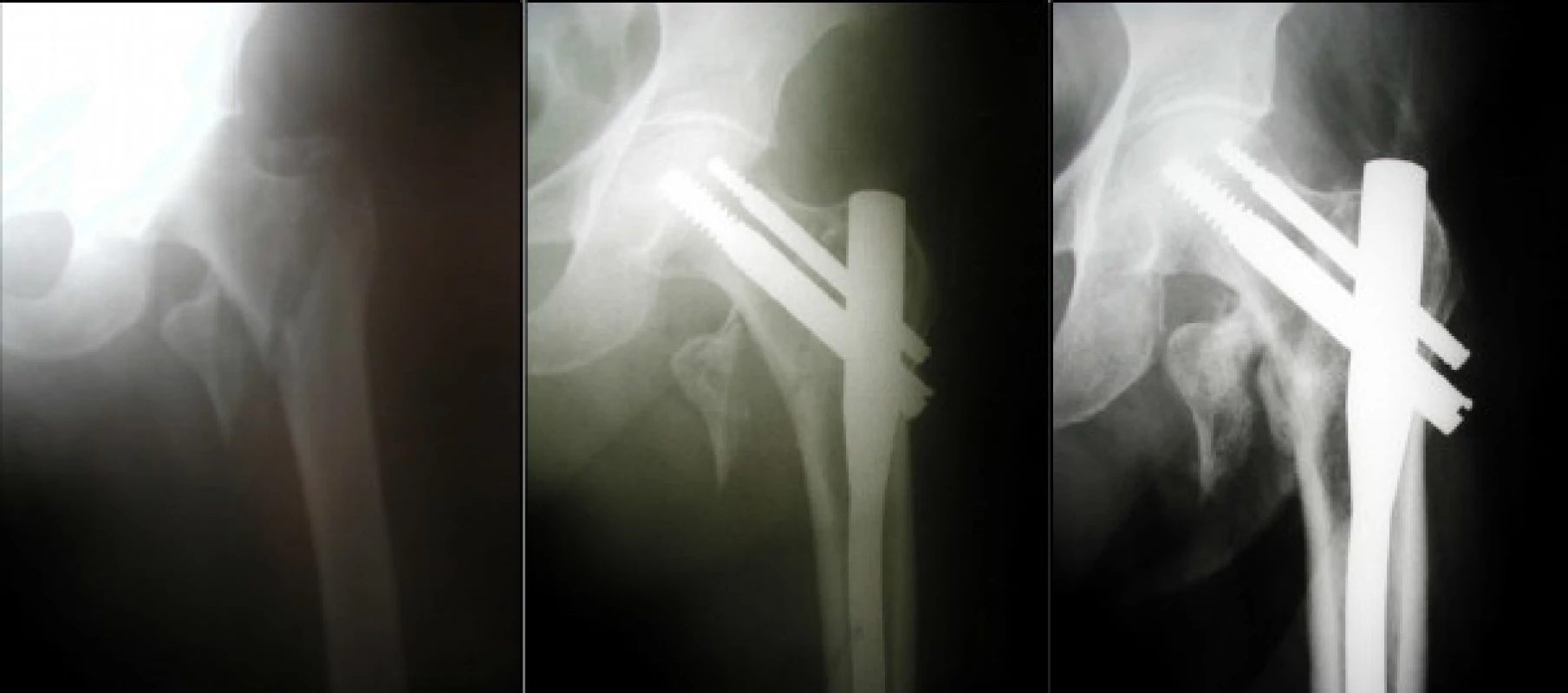 Pacientka, 95 let s nestabilní pertrochanterickou zlomeninou (a), stabilizovanou PFN – snímek po operaci (b), za 12 týdnů došlo ke kompresi v místě zlomeniny a k lehké laterální prominenci obou šroubů (c)