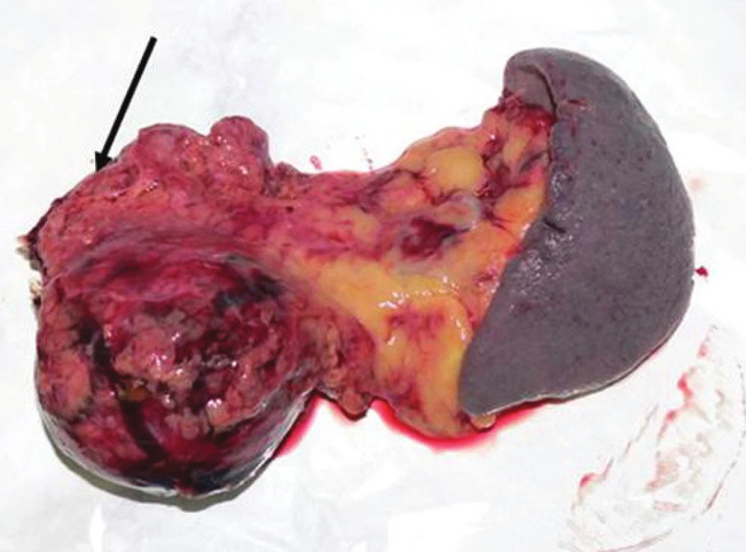 Resekovaný distálny pankreas so slezinou, resekčná línia označená šípkou
Fig. 8. The resected distal pancreas and spleen, the resection line marked with an arrow