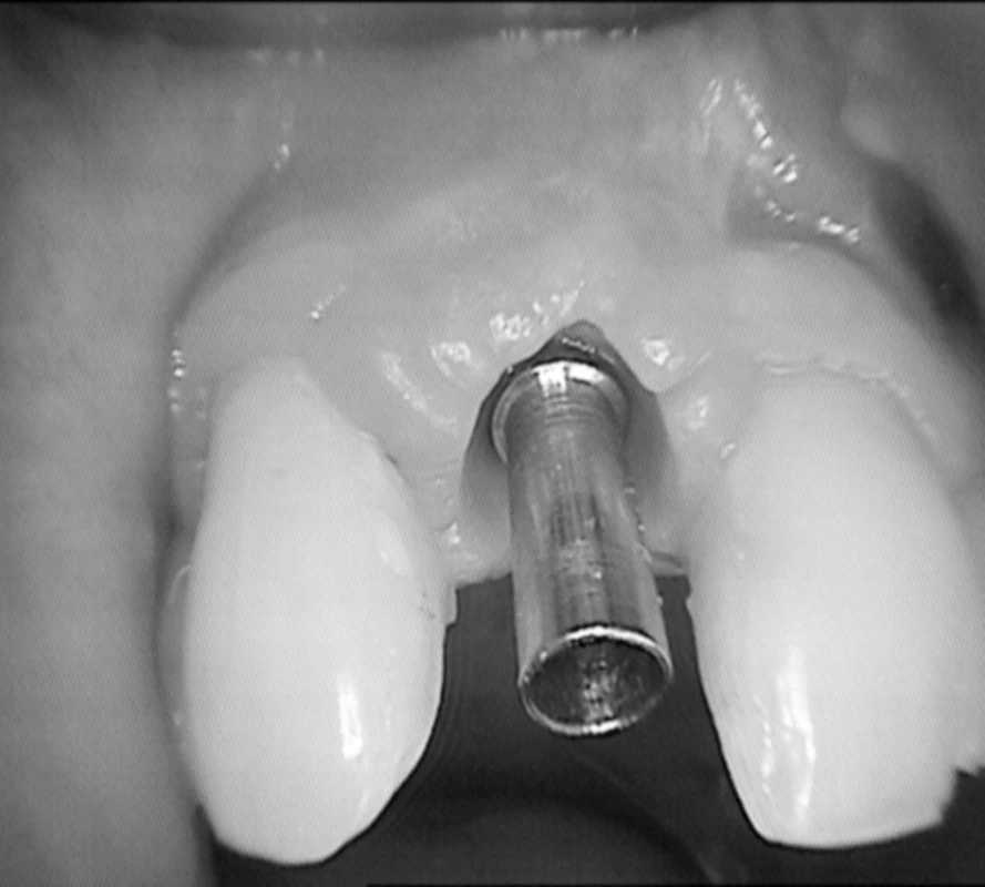 Na implantát nasadená jednoduchá valcová titanová nadstavba. (Foto: Eurodent medima, s.r.o.)