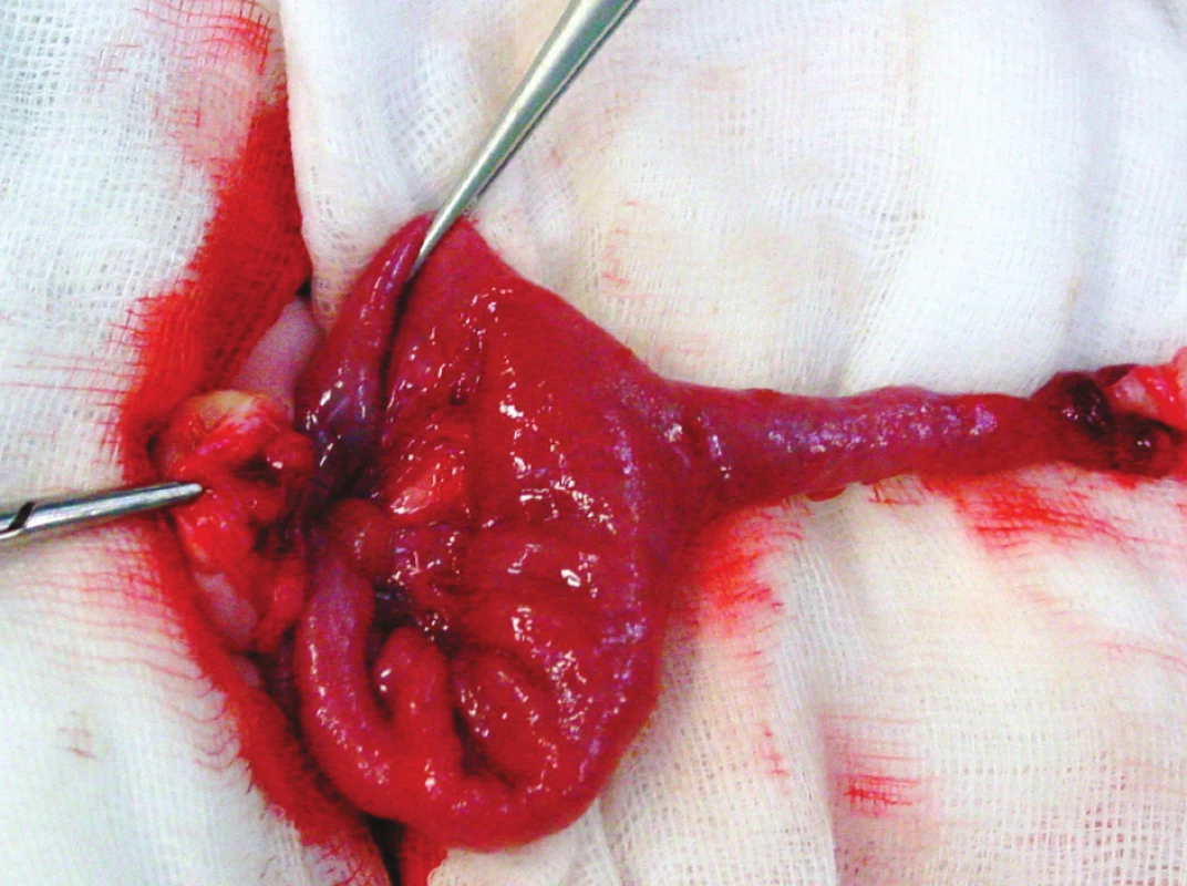 Ductus omphaloentericus persistens před resekcí. Zevní ústí píštěle se střevní sekrecí
Fig. 2. Ductus omphaloentericus persistens prior to its resection. The external orifice of the fistule with intestinal secretion