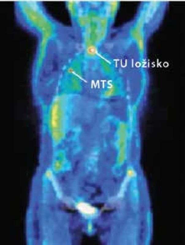 Pozitrónová emisná tomografia (PET) s &lt;sup&gt;18&lt;/sup&gt;fluorodeoxyglukózou