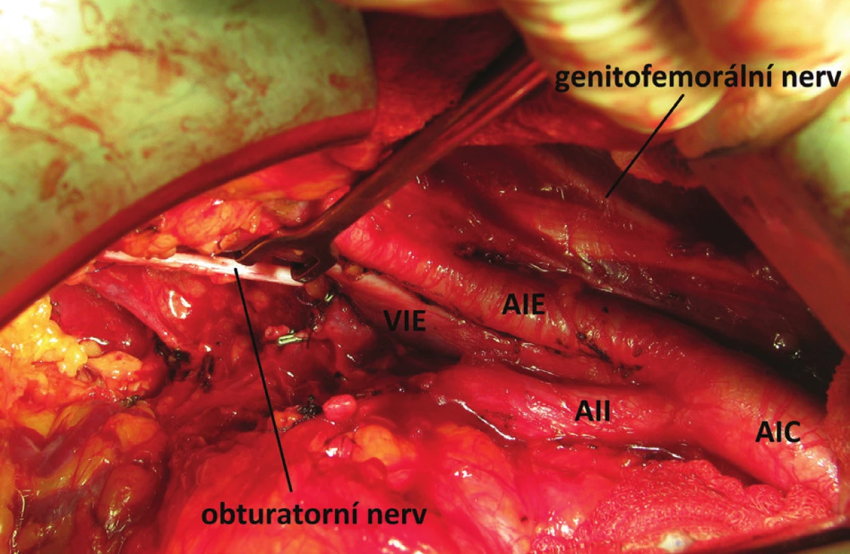 Peroperační snímek zobrazující pánevní lymfadenektomii
Fig. 2: Intraoperative picture illustrating pelvic lymph node dissection