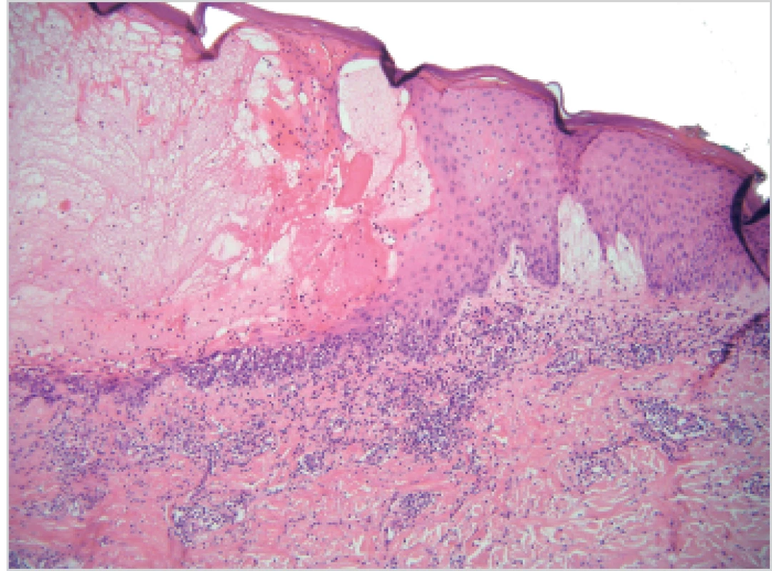 Intraepidermální neakantolytická bula s nekrózou keratinocytů a edémem sousedních dermálních papil – obraz blízký erythema multiforme