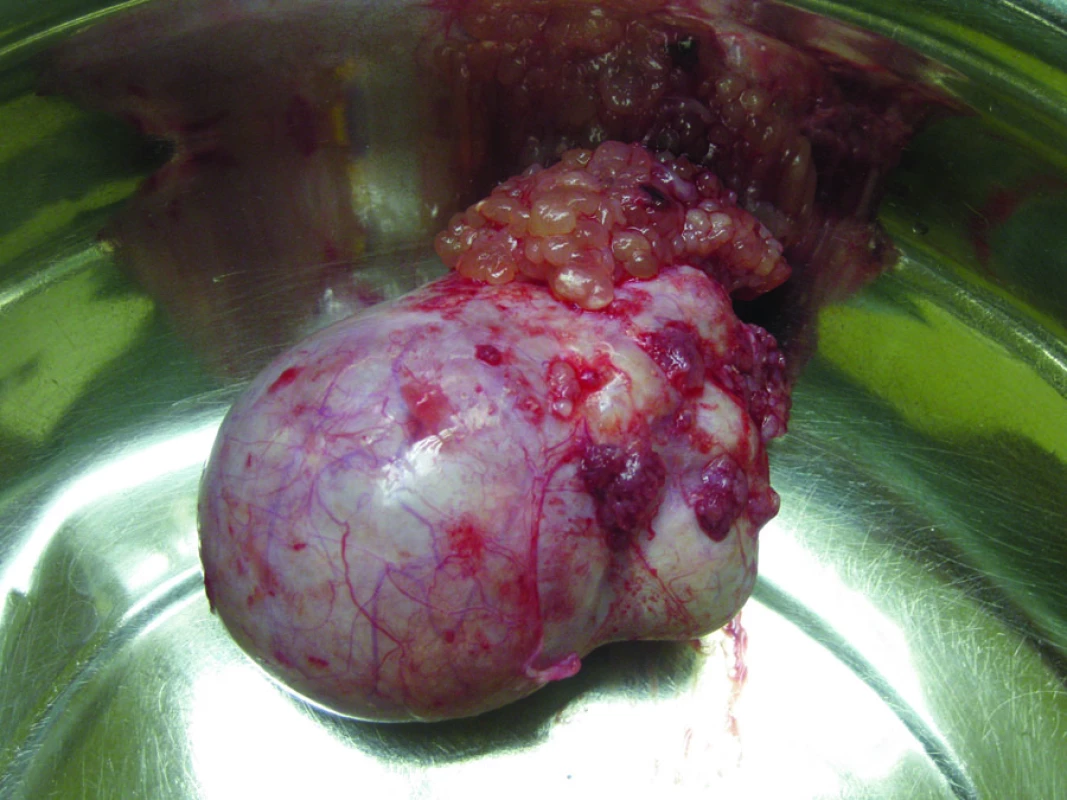 Mucinózní ovariální borderline tumor (mikroinvazivní intestinální subtyp).
