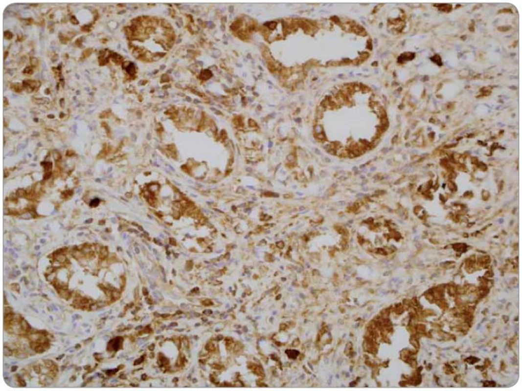 Detekce neuroendokrinní diferenciace v nádorových buňkách prokazující fokální silnou granulární pozitivitu. Imunohistochemická reakce s protilátkou proti chromograninu (Chromogranin, Biogenex), zvětšení 400krát.