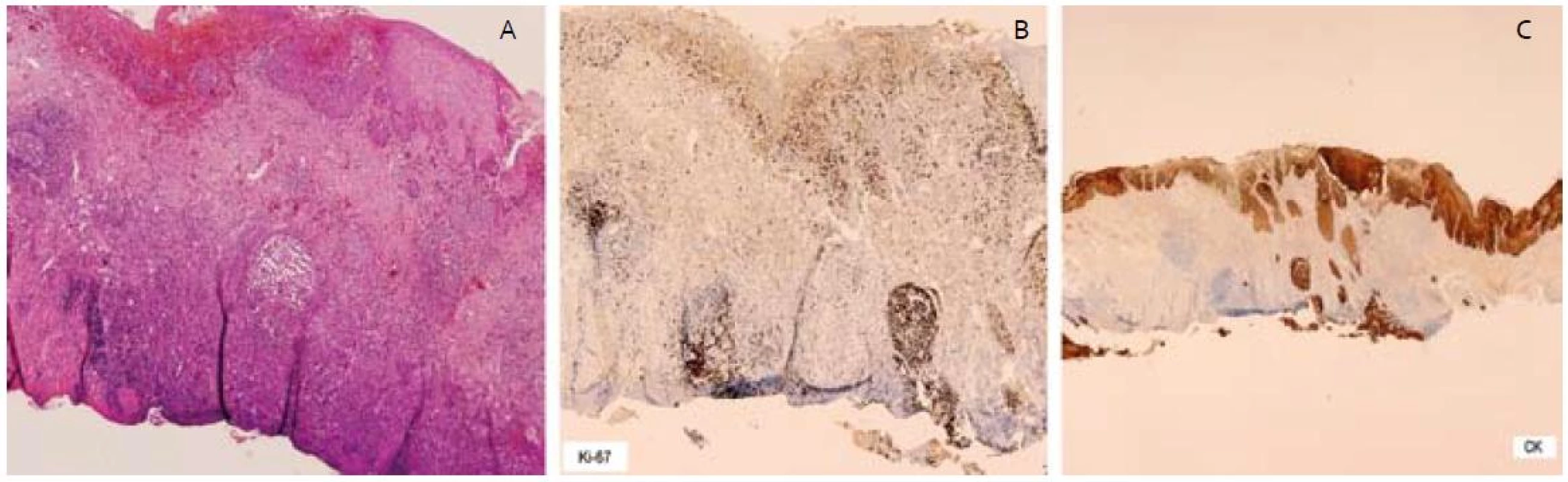 – invadujúce čapy ESCC, B – vysoká proliferačná aktivita Ki-67 v čapoch, C – imunohistochémia – cykeratín, čap dosahujúci spodinu resekátu.
Fig. 4. A – invasive squamous cell carcinoma of esophagus with infiltrating border, B – high proliferative activity of Ki-67, C – cytoceratin immunohistochemical staining, ESCC reached base of resection specimen.