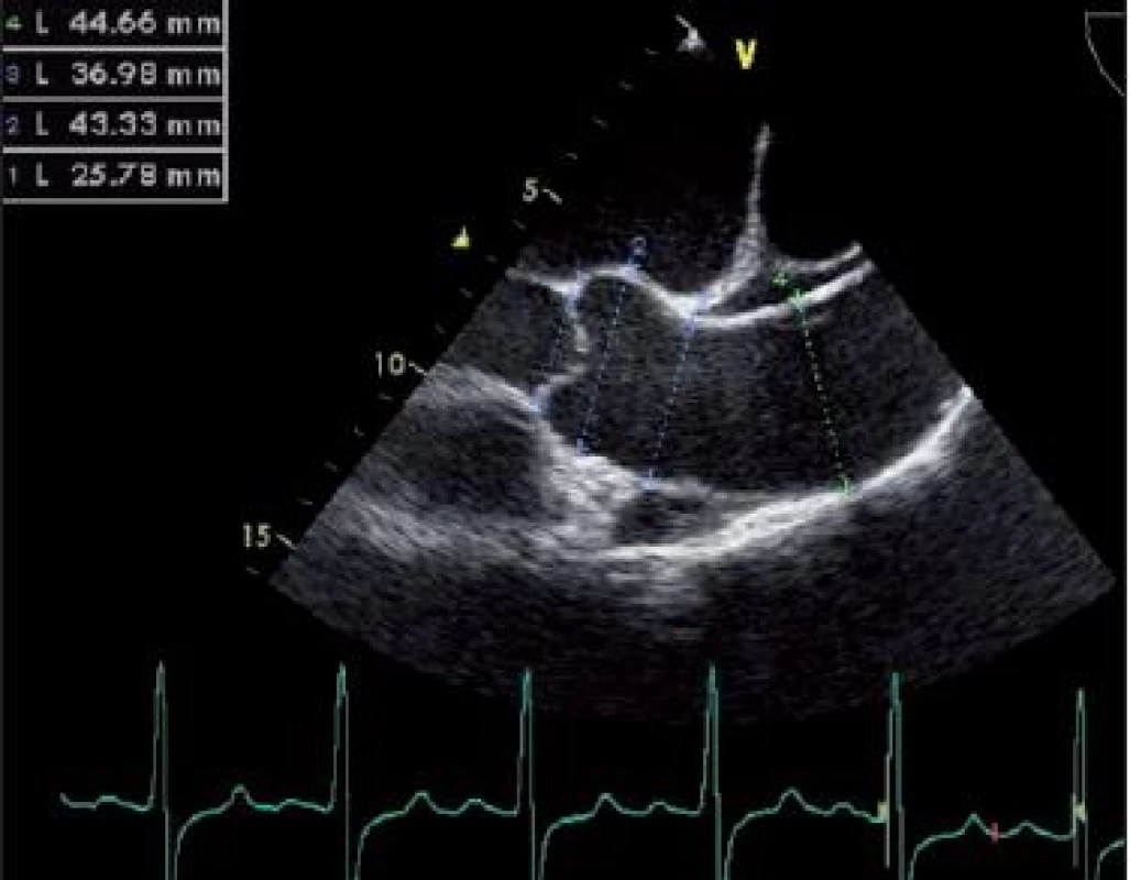 Transezofageální UZ vyšetření v dlouhé ose u nemocného s biku spidální aortální chlopní. Je změřen diametr anulu aortální chlopně (1), aortálního bulbu (2), sinotubulární junkce (3) a ascendentní aorty (4).