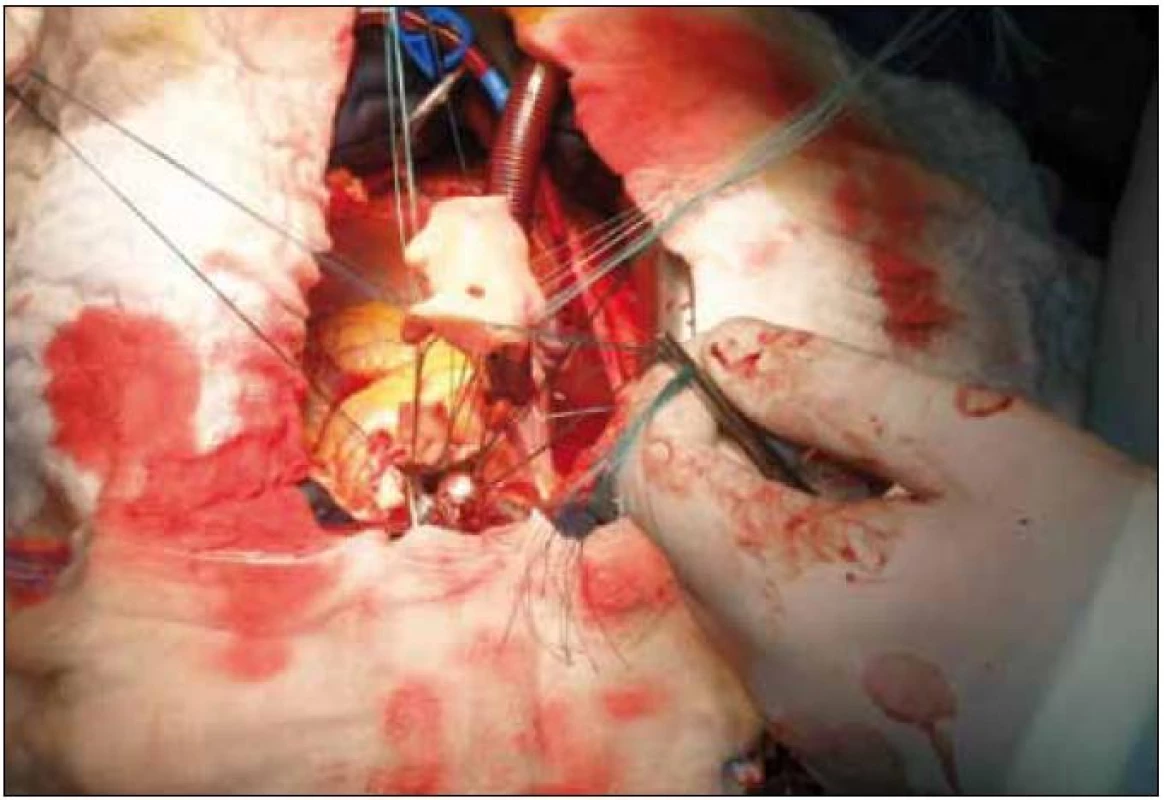 Peroperačná fotografia – implantácia homograftu do aortálnej pozície.