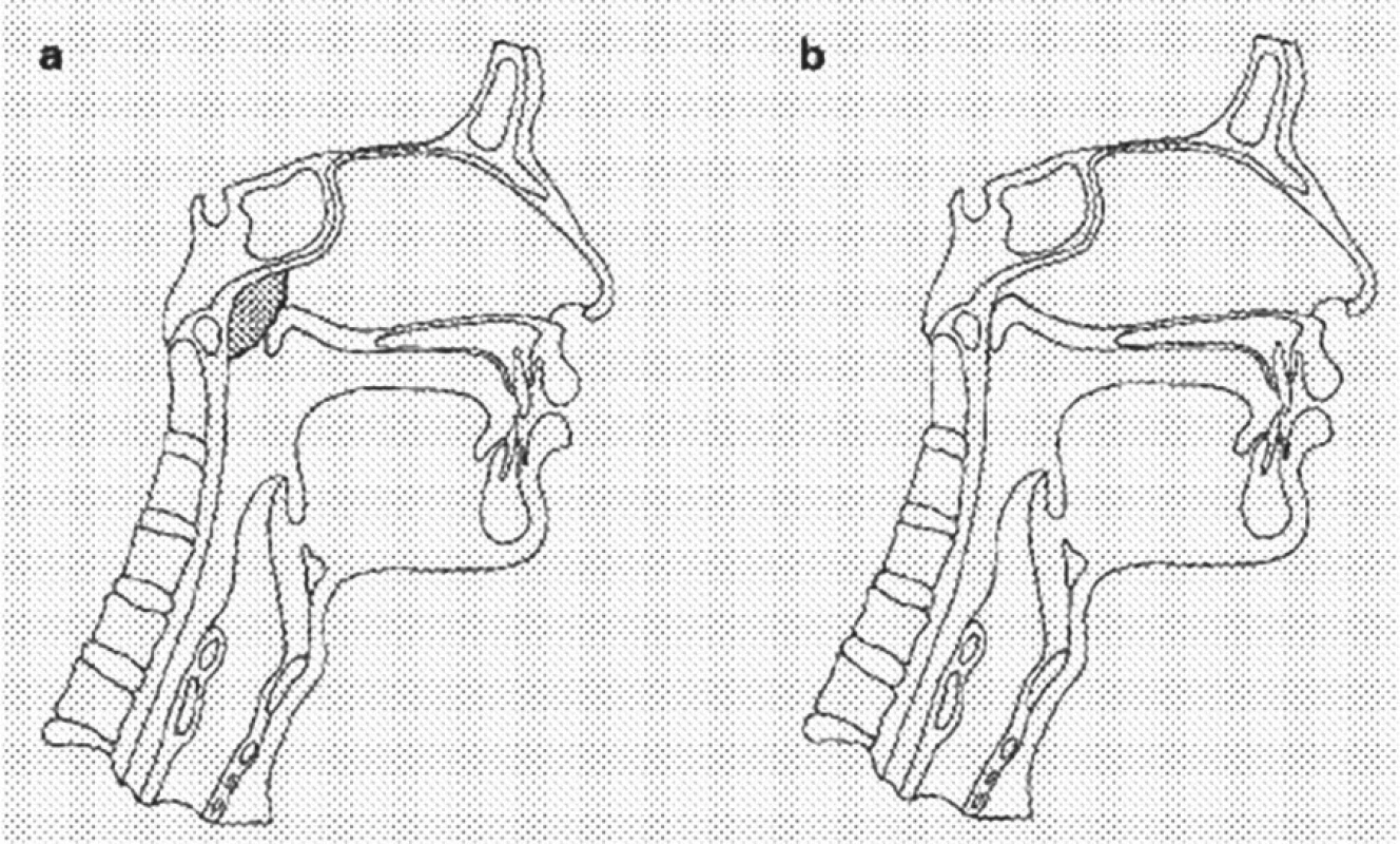 Schematická kresba veloadenoidního (a) a záklopkového (b) velofaryngeálního uzávěru. Převzato od Maryn, 2004 (8).