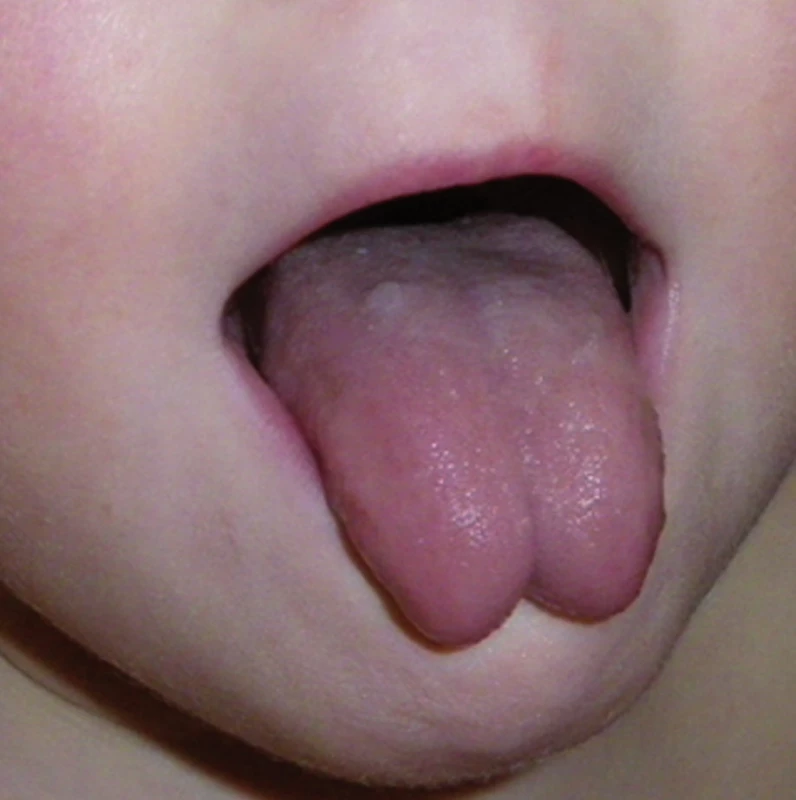 Protruze jazyka pacienta se zkrácenou podjazykovou uzdičkou.
Fig. 1. Protrusion of tongue in a patient with short frenulum.