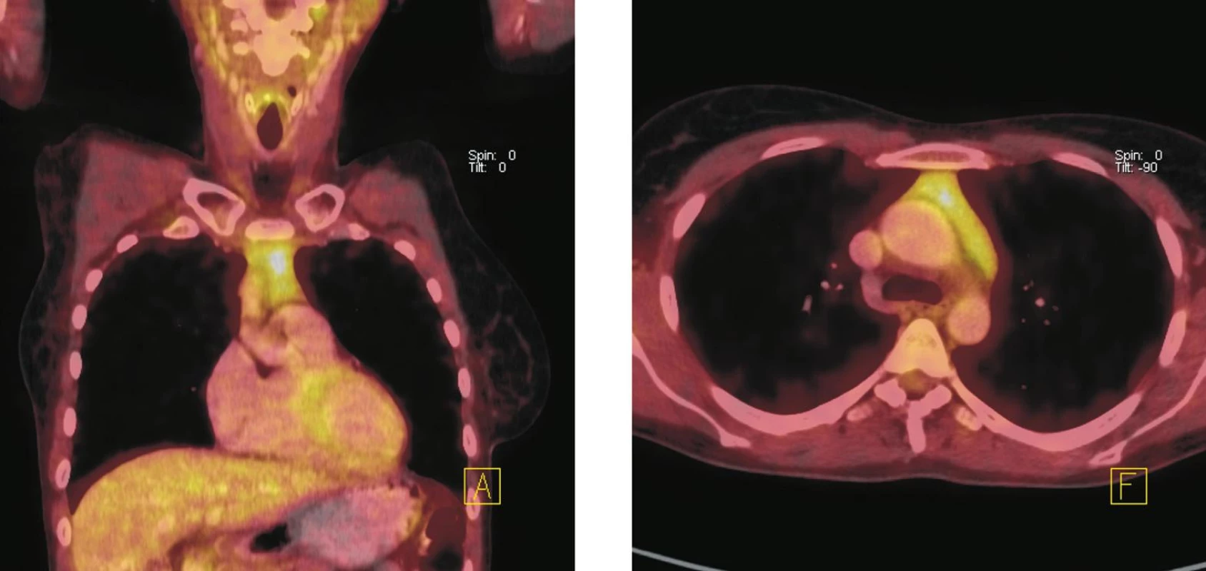 Fúze PET a CT řezů – koronální (vlevo), transverzální (vpravo). Zvýšená akumulace &lt;sup&gt;18&lt;/sup&gt;F-FDG v měkkotkáňové struktuře horního předního mediastina, která nebyla patrná při vstupním vyšetření před zahájením imunochemoterapie. Velikost ani charakter popsané struktury se při pozdějším kontrolním vyšetření nezměnily. Nález hodnocen jako aktivace tkáně thymu po chemoterapii.